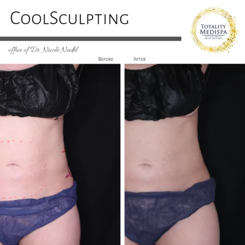Coolsculpting & Fat Dissolving Injections Before and After Photo by Totality Medispa in Charleston, SC