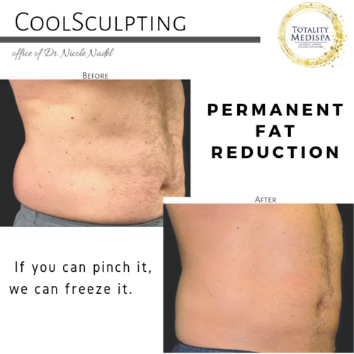 Coolsculpting & Fat Dissolving Injections Before and After Photo by Totality Medispa in Charleston, SC