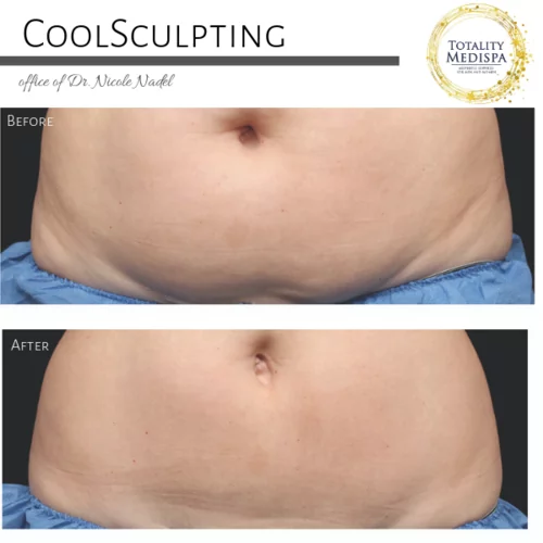 Coolsculpting & Fat Dissolving Injections Before and After Photo by Totality Medispa in Charleston, SC