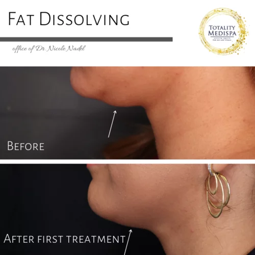 Coolsculpting & Fat Dissolving Injections Before and After Photo by Totality Medispa in Charleston, SC