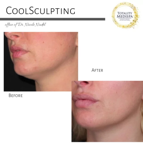 Coolsculpting & Fat Dissolving Injections Before and After Photo by Totality Medispa in Charleston, SC