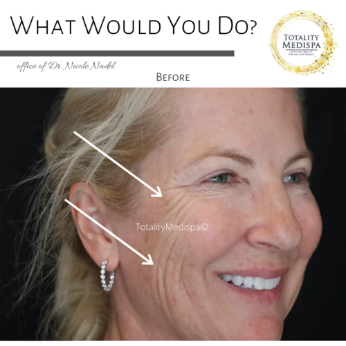Coolsculpting & Fat Dissolving Injections Before and After Photo by Totality Medispa in Charleston, SC