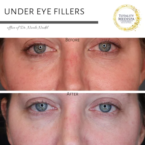 Fillers Before and After Photo by Totality Medispa in Charleston, SC