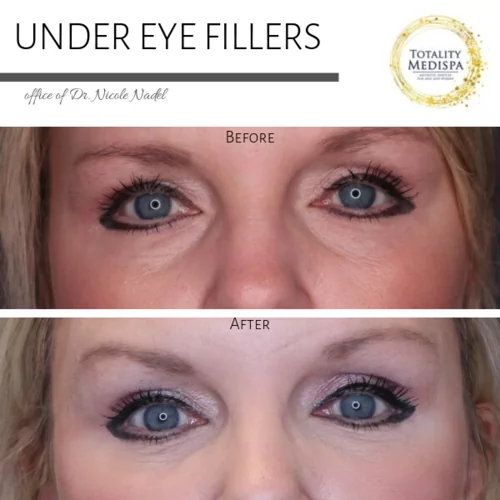 Fillers Before and After Photo by Totality Medispa in Charleston, SC