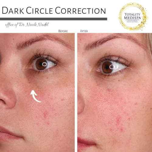 Fillers Before and After Photo by Totality Medispa in Charleston, SC