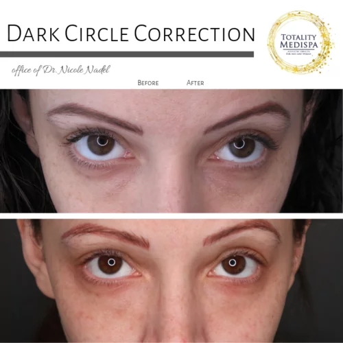 Fillers Before and After Photo by Totality Medispa in Charleston, SC