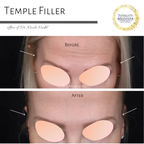 Fillers Before and After Photo by Totality Medispa in Charleston, SC