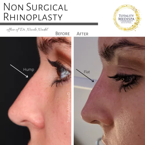 Fillers Before and After Photo by Totality Medispa in Charleston, SC
