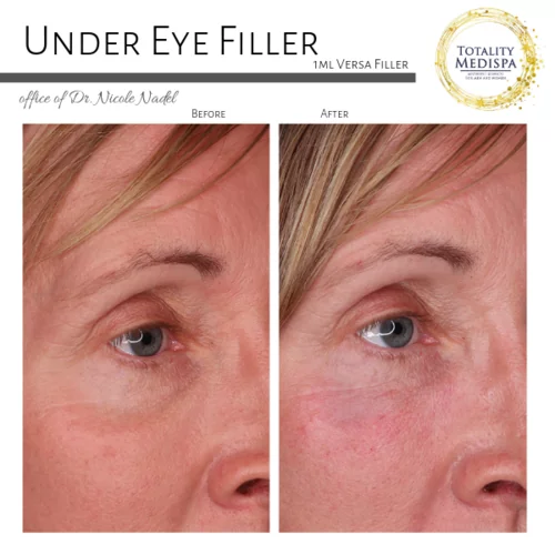 Fillers Before and After Photo by Totality Medispa in Charleston, SC
