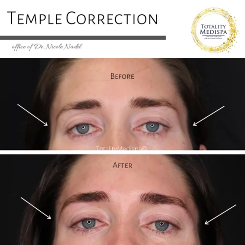 Fillers Before and After Photo by Totality Medispa in Charleston, SC