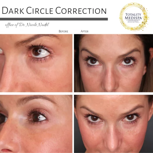 Fillers Before and After Photo by Totality Medispa in Charleston, SC