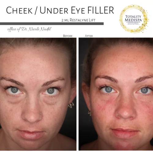 Fillers Before and After Photo by Totality Medispa in Charleston, SC