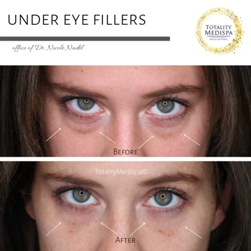 Fillers Before and After Photo by Totality Medispa in Charleston, SC