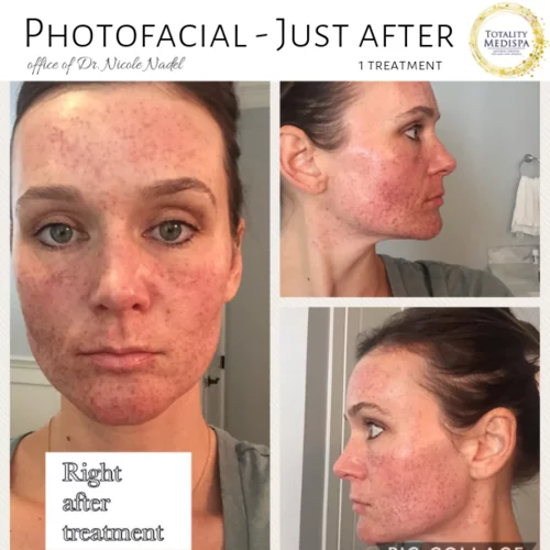 IPL Photofacial Before and After Photo by Totality Medispa in Charleston, SC