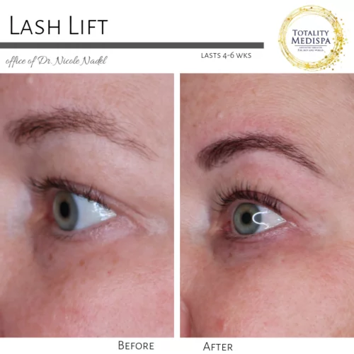 Lashes Extensions and Lift/Tint Before and After Photo by Totality Medispa in Charleston, SC