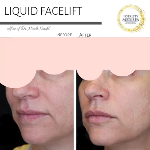 Lip Filler Before and After Photo by Totality Medispa in Charleston, SC