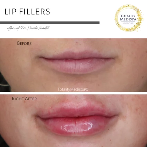 Lip Filler Before and After Photo by Totality Medispa in Charleston, SC