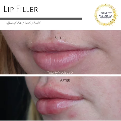 Lip Filler Before and After Photo by Totality Medispa in Charleston, SC