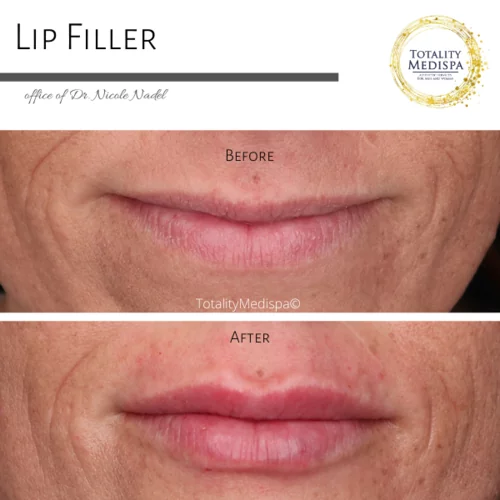 Lip Filler Before and After Photo by Totality Medispa in Charleston, SC