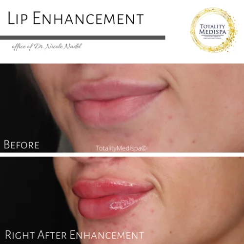 Lip Filler Before and After Photo by Totality Medispa in Charleston, SC