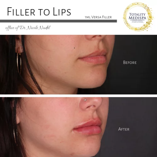 Lip Filler Before and After Photo by Totality Medispa in Charleston, SC
