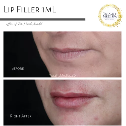 Lip Filler Before and After Photo by Totality Medispa in Charleston, SC