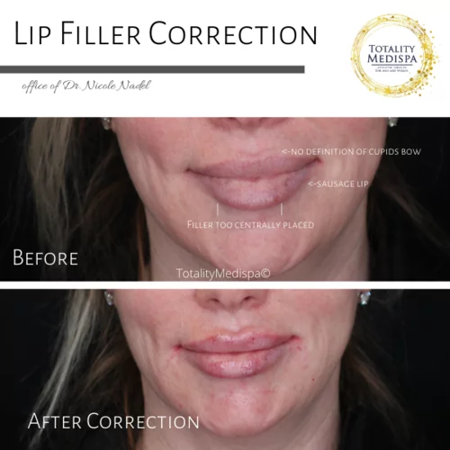 Lip Filler Before and After Photo by Totality Medispa in Charleston, SC