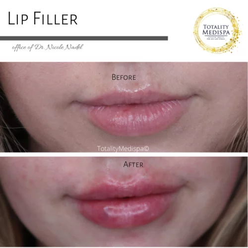 Lip Filler Before and After Photo by Totality Medispa in Charleston, SC