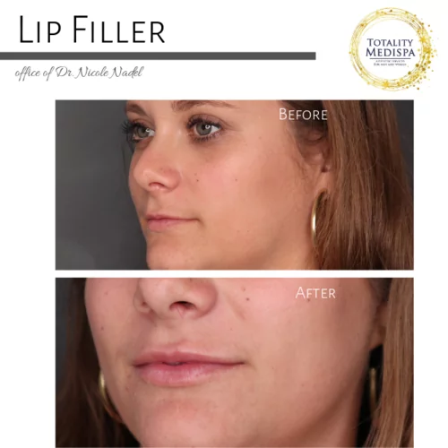 Lip Filler Before and After Photo by Totality Medispa in Charleston, SC