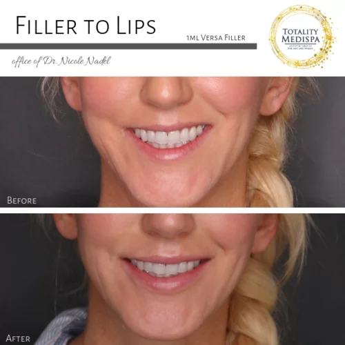 Lip Filler Before and After Photo by Totality Medispa in Charleston, SC