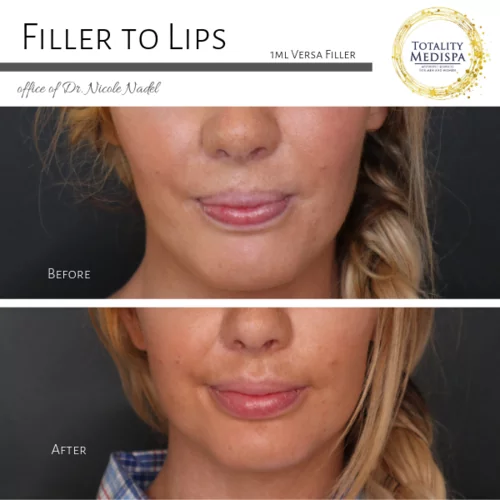 Lip Filler Before and After Photo by Totality Medispa in Charleston, SC