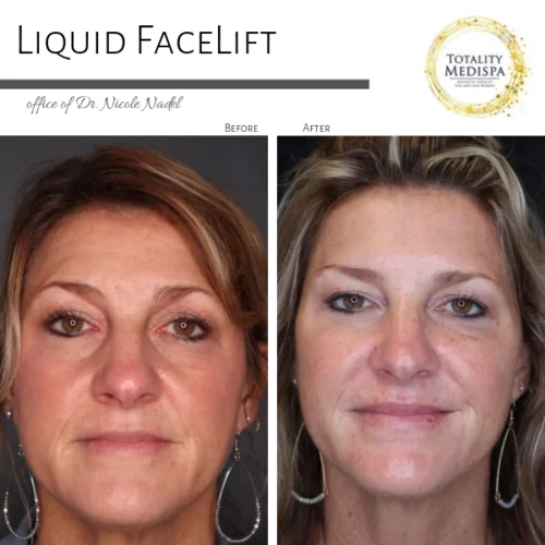 Liquid Facelift (Fillers and Botox) Before and After Photo by Totality Medispa in Charleston, SC