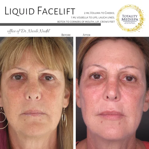 Liquid Facelift (Fillers and Botox) Before and After Photo by Totality Medispa in Charleston, SC