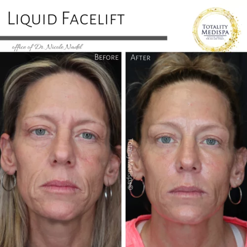 Liquid Facelift (Fillers and Botox) Before and After Photo by Totality Medispa in Charleston, SC