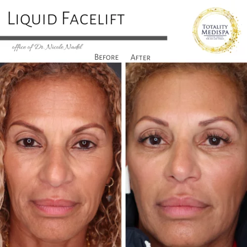 Liquid Facelift (Fillers and Botox) Before and After Photo by Totality Medispa in Charleston, SC