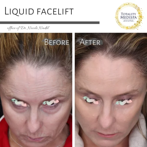 Liquid Facelift (Fillers and Botox) Before and After Photo by Totality Medispa in Charleston, SC
