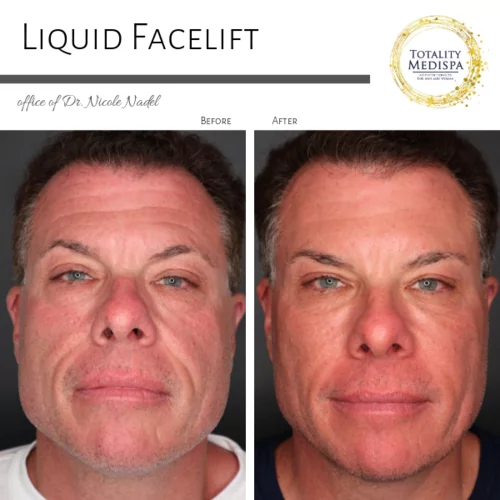Liquid Facelift (Fillers and Botox) Before and After Photo by Totality Medispa in Charleston, SC