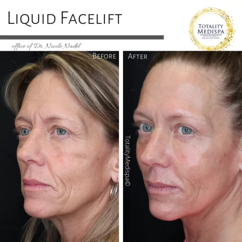 Liquid Facelift (Fillers and Botox) Before and After Photo by Totality Medispa in Charleston, SC