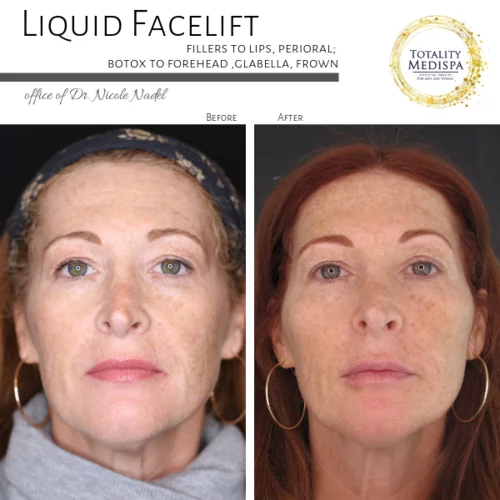 Liquid Facelift (Fillers and Botox) Before and After Photo by Totality Medispa in Charleston, SC