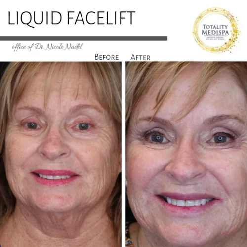 Liquid Facelift (Fillers and Botox) Before and After Photo by Totality Medispa in Charleston, SC