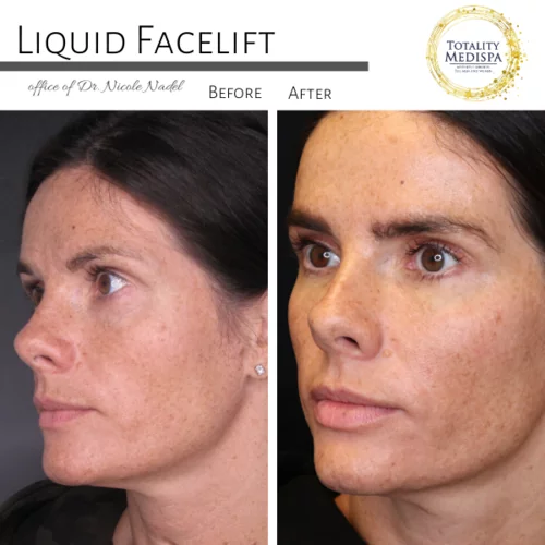 Liquid Facelift (Fillers and Botox) Before and After Photo by Totality Medispa in Charleston, SC