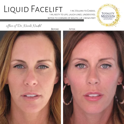 Liquid Facelift (Fillers and Botox) Before and After Photo by Totality Medispa in Charleston, SC