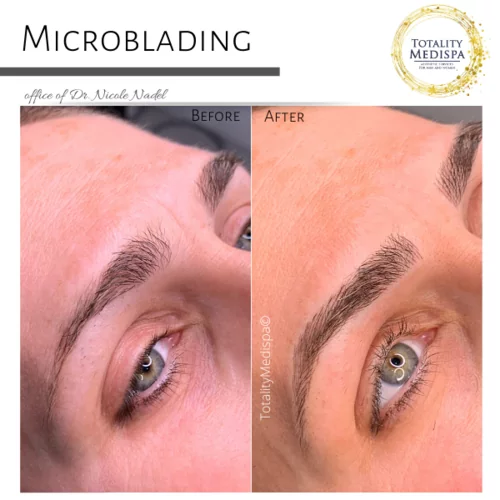 Microblading Before and After Photo by Totality Medispa in Charleston, SC