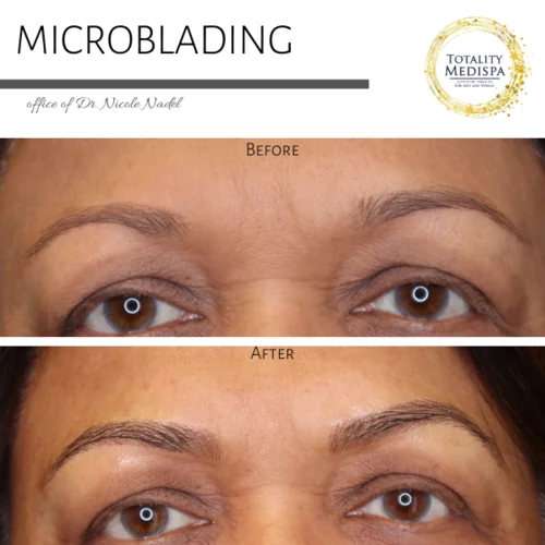 Microblading Before and After Photo by Totality Medispa in Charleston, SC