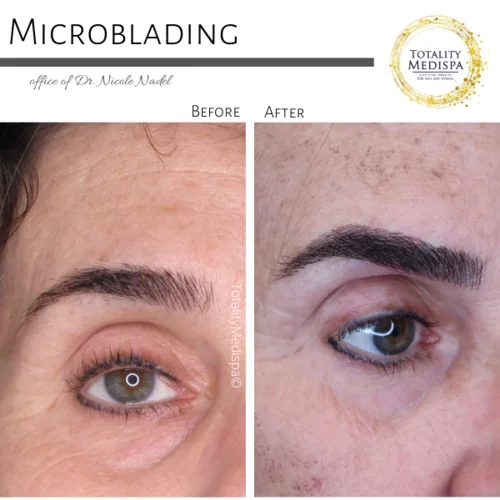 Microblading Before and After Photo by Totality Medispa in Charleston, SC