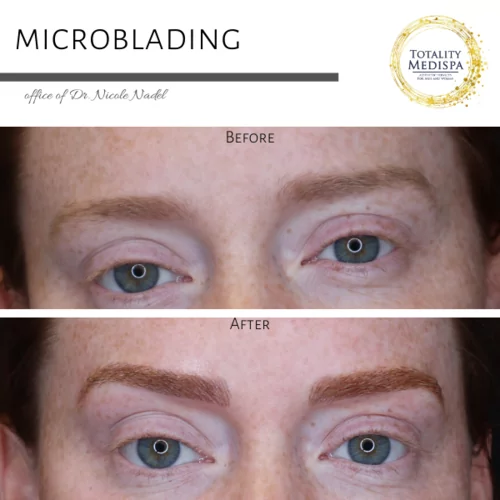 Microblading Before and After Photo by Totality Medispa in Charleston, SC