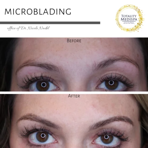 Microblading Before and After Photo by Totality Medispa in Charleston, SC