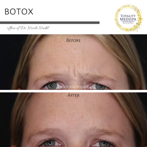 Neurotoxins (Botox, Newtox, Xeomin) Before and After Photo by Totality Medispa in Charleston, SC