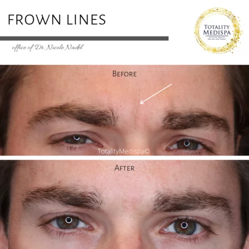 Neurotoxins (Botox, Newtox, Xeomin) Before and After Photo by Totality Medispa in Charleston, SC
