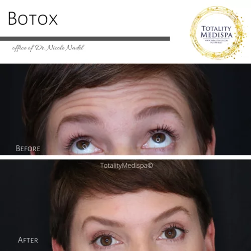 Neurotoxins (Botox, Newtox, Xeomin) Before and After Photo by Totality Medispa in Charleston, SC